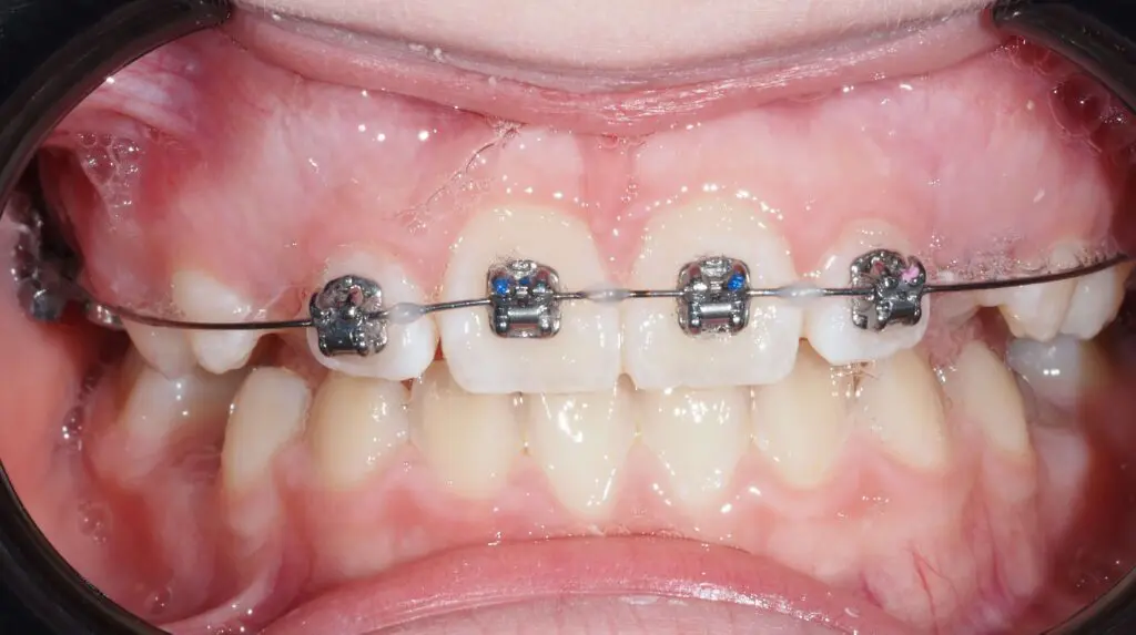 stały aparat ortodontyczny 2x4