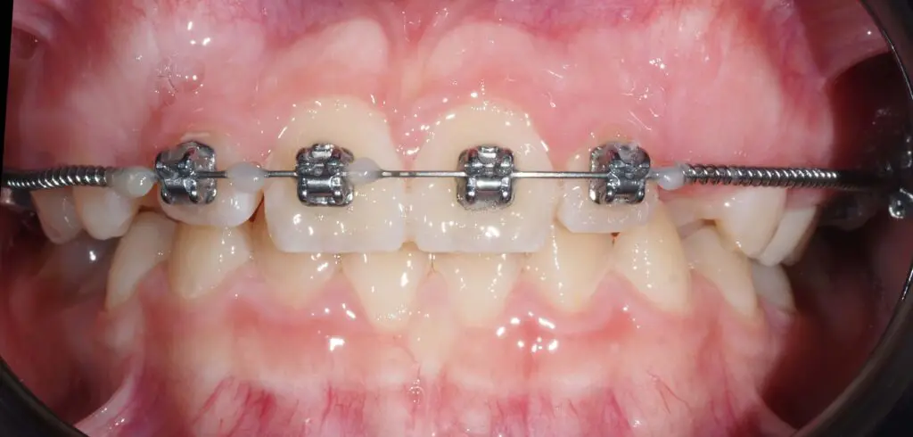 stały aparat ortodontyczny 2x4 sprężyna