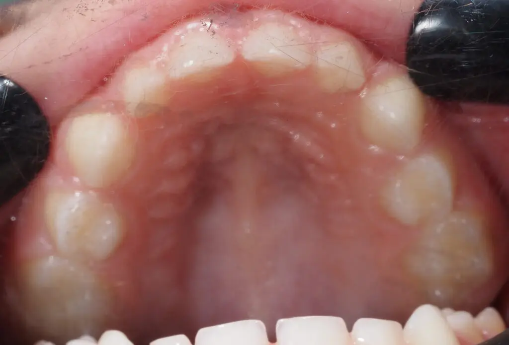 wysokie i wąskie podniebienie u dziecka