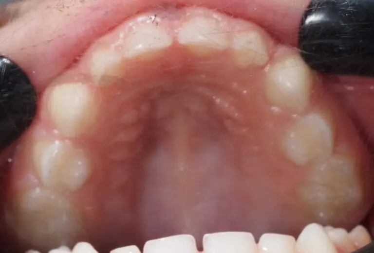 wysokie i wąskie podniebienie u dziecka