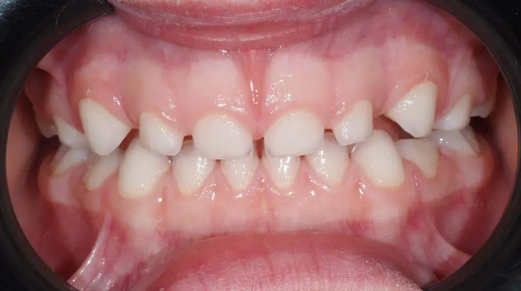 zgryz pieciolatka efekt leczenia ortodontycznego