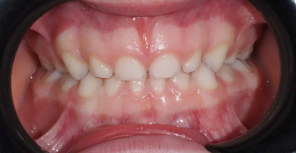 zgryz pieciolatka przed leczeniem ortodontycznym