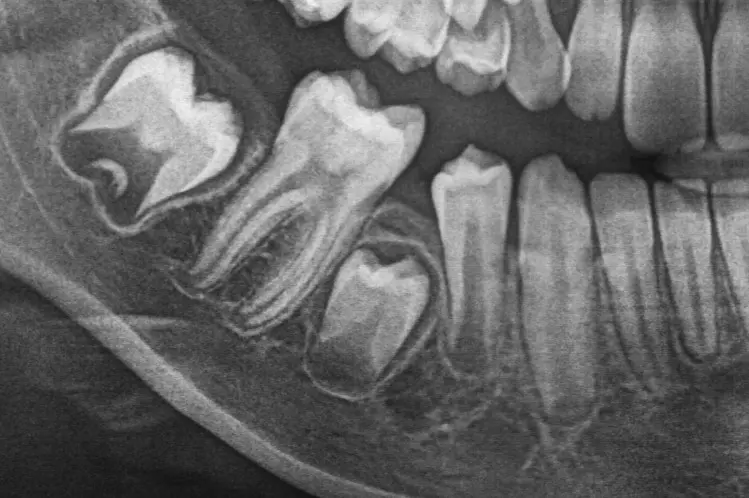 zdjęcie RTG pokazuje brak miejsca do wyrznięcia się piątki