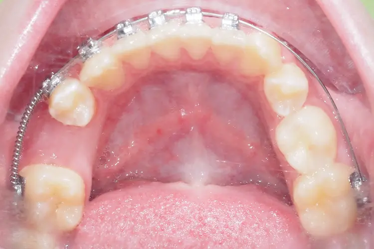 efekt leczenia ortodontycznego