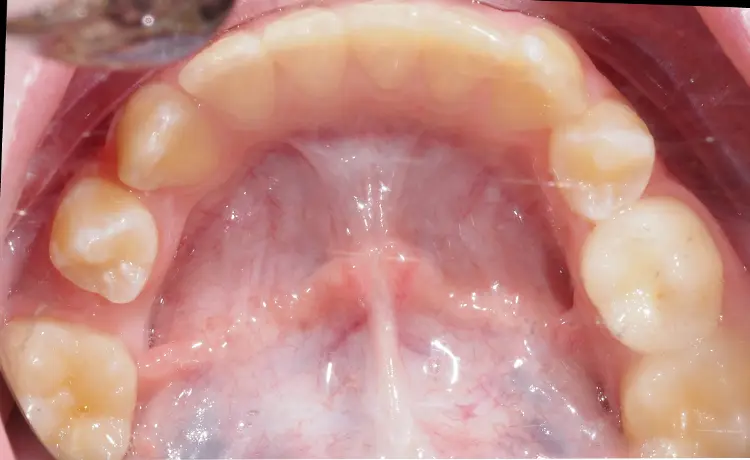 brak miejsca na ząb stały u dziecka